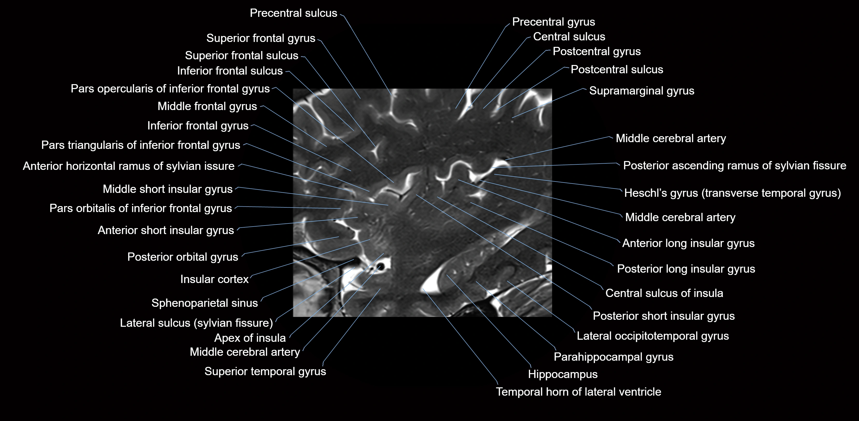 Insula cross section anatomy MRI sagittal 3t labelled image-img-00007.webp